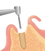 あごの骨にドリルで、人工歯根を埋め込むための孔(あな)を開ける。