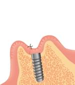 歯肉を縫い合わせ、歯槽骨に人工歯根がなじむように、2～3ヵ月おく。　
