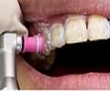 ホワイトニングについての説明／歯の表面をクリーニング